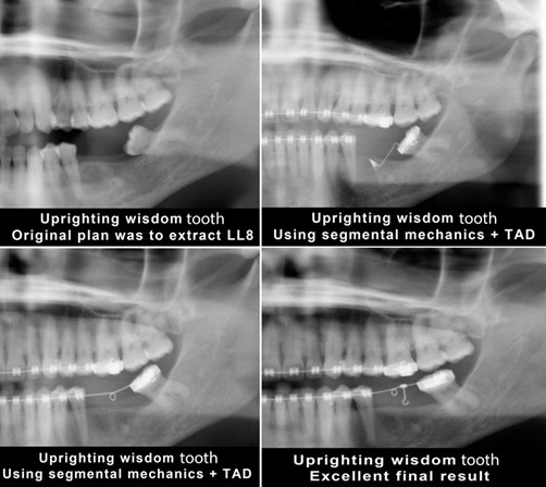 Upright molars with mini implants TADs